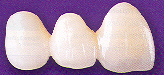 Anterior Dental Bridge